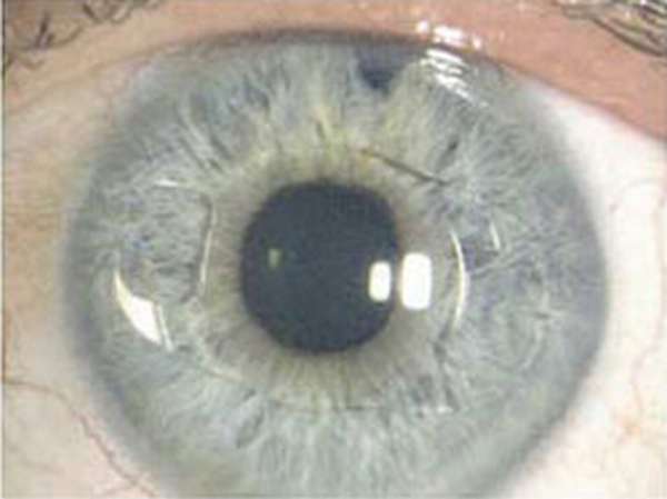Интраокулярные линзы при афакии глаз